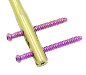 Distal Femur <strong>Nail</strong> for Fracture <strong>Fixation</strong> <strong>Intramedullary</strong> <strong>Nail</strong> System for Supracondylar and Femoral Shaft Fractures Titanium - Product Image 4