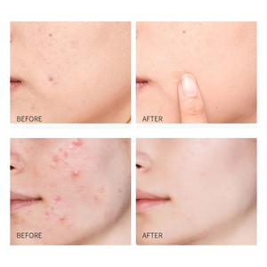 Patch anti-acné hydrocolloïde imperméable personnalisé à l'huile d'arbre à thé, à l'aloe vera et à la vitamine C, hydratant et cicatrisant - Product Image 6