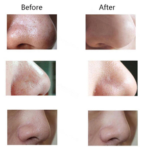 Máquina <span class=keywords><strong>de</strong></span> Succión <span class=keywords><strong>de</strong></span> Puntos Negros <span class=keywords><strong>de</strong></span> Belleza Más Vendida en Europa, Limpiador Facial Eléctrico <span class=keywords><strong>de</strong></span> Poros / Removedor <span class=keywords><strong>de</strong></span> Puntos Negros al Vacío - Product Image 6
