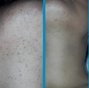 Newest Desktop Three Wavelength 755nm/1064nm/ 808nm Diode Hair Removal Machine Portable High Power Hair Removal - Product Image 6