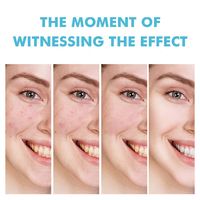 Crème Réparatrice Cicatrices d'Acné, Gel Anti-Taches, Lisse la Peau, Resserre les Pores, Traitement Visage Efficace et Rapide