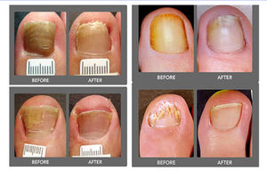 2026 60 W 980nm Máquina Láser Diodo Vascular de 980nm para Eliminación de Arañas Vasculares y Hongos en <span class=keywords><strong>las</strong></span> Uñas, Láser Podológico para Salón y Clínica - Product Image 5