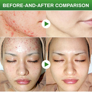 ครีมทาหน้าเจลกรดซาลิไซลิกและโลชั่นครีมรักษาสิวที่ทำให้รอยสิวจางลงและลดจุดด่างดำลงบรรเทาอาการ<span class=keywords><strong>แดง</strong></span>และบวม - Product Image 3
