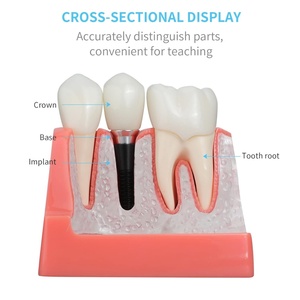 4 Times Medical Science Education Studying Dental Implant Model Removable <b>Teeth</b> Multi-Purpose <b>Teeth</b> <b>Whitening</b> Accessories - Product Image 3