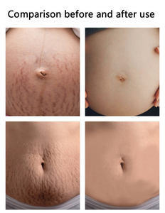 OEM réglé de crème et d'huile d'<span class=keywords><strong>anti</strong></span> <span class=keywords><strong>vergeture</strong></span> de cicatrice de grossesse de retrait <span class=keywords><strong>efficace</strong></span> de vergetures - Product Image 4