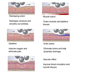 Máquina de Adelgazamiento con Rodillos Internos de 360 Grados, Drenaje Linfático, Reducción de Celulitis, Terapia Endospheres, Rodillo Corporal - Product Image 6