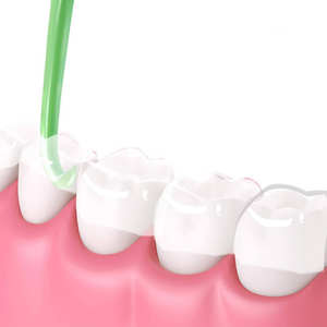 Dental Clear Aligner Remover Entfernungs werkzeug Kiefer ortho pä discher Halter Unsichtbare Zahnspangen Entfernen Sie den Haken Kunststoff werkzeug - Product Image 1
