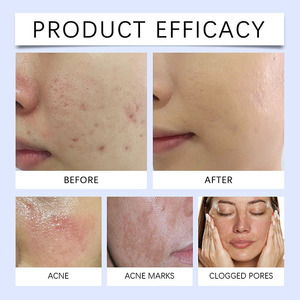 OEM al por mayor 20g crema facial hidratante antiacné removedor de espinillas y manchas oscuras para piel grasa ingrediente principal ácido salicílico - Product Image 5