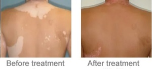 เครื่องฉายแสงยูวีสำหรับรักษาโรคผิวหนัง KN-4005 แบบเต็มตัว UVA/NB-UVB 311nm สำหรับโรคด่างขาว สะเก็ดเงิน และกลาก - Product Image 6