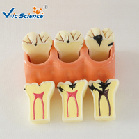 Modelo de Descomposición de Caries Dentales con Aumento 4X, Modelo Desmontable de la Estructura Interna del Diente Deciduado, CE/ISO/ROHS/CNAS