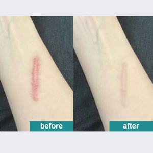 Custom Silicone Scar Patch Oem/odm - Medical-grade Adhesive,Reusable Scar Sheets for <b>Post</b>-surgery Recovery & Skin Protection - Product Image 6