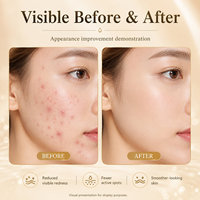 Crème pour le visage contre l'acné, élimine les marques d'acné, resserre les pores, adoucit et lisse la peau, améliore la peau acnéique, crème de soin du visage, crème de soin de la peau