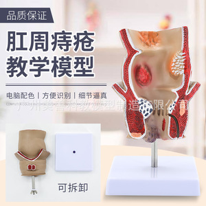 Modèle de hémorroïdes rectales et de lésions colorectales ; hémorroïdes rectales internes et externes et modèle anorectal ; pathologie rectale. - Product Image 1