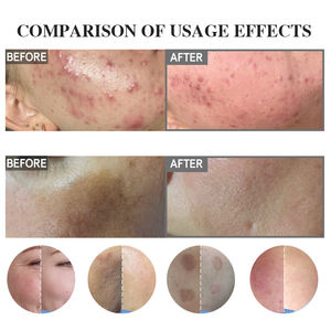 Alga <span class=keywords><strong>Peeling</strong></span> aghi Bio <span class=keywords><strong>Peeling</strong></span> ed esfoliazione 70% puro Bioneedling Spongilla Spicules Peel in polvere trattamento Acne e sbiancamento B - Product Image 4