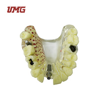 Modèle d'implant dentaire anatomique en résine (UM-2007) - Demi-jeu supérieur avec carie, fracture de la racine et kyste, en résine durable
