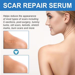 Gel réparateur de cicatrices en <span class=keywords><strong>silicone</strong></span> ETRUN ALISA, marque privée, efficace contre l'acné, les boutons, les vergetures, les marques de cicatrices, crème anti-cicatrices - Product Image 6