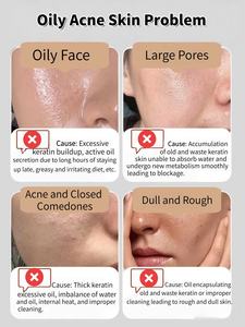 Suero <span class=keywords><strong>de</strong></span> rejuvenecimiento <span class=keywords><strong>de</strong></span> exfoliación química <span class=keywords><strong>de</strong></span> triácido suave con <span class=keywords><strong>AHA</strong></span> BHA PHA, complejo multiácido, solución <span class=keywords><strong>de</strong></span> equilibrio Hydra para aceite y piel con acné - Product Image 2