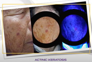 Lampe de Wood médicale à prix d'usine pour le test du vitiligo et du <span class=keywords><strong>psoriasis</strong></span>, produit de beauté et de soins personnels - Product Image 5