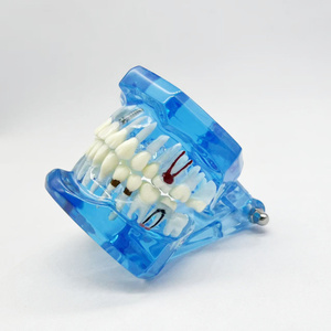 Modèle de réparation bleu école de médecine restauration des nerfs dentaires modèle humain modèle dentaire médical - Product Image 2