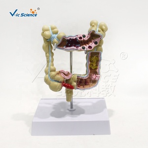 Modelo Patológico <span class=keywords><strong>de</strong></span> Intestino Grueso: Tuberculosis, Enfermedad <span class=keywords><strong>de</strong></span> Crohn, Colitis Ulcerativa, Inflamación - Product Image 2