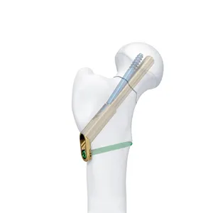 Placa de Implante para Trauma con Bloqueo <span class=keywords><strong>Proximal</strong></span>, Distal, Lateral, Humeral, Radiáculo, Única, Femoral y Tibial - Product Image 5