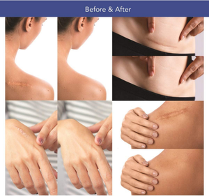 แผ่นแปะซิลิโคนเจลสำหรับลบรอยแผลเป็นที่ปิดรอยแผลเป็น - Product Image 4