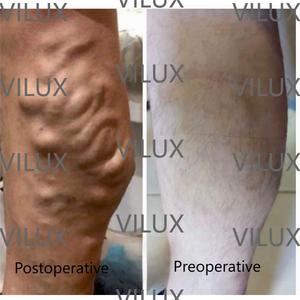 Láser de Diodo Médico NexaBox 1470nm 980nm para <span class=keywords><strong>Piernas</strong></span>, Dispositivo para el Dolor de <span class=keywords><strong>Piernas</strong></span>, Apariencia Personalizable, Longitud de Onda y Potencia - Product Image 2