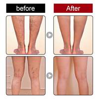 Crème Gel Herbale Apaisante pour Phlébite, Angéite et Varices, Traitement Gel pour Varicosités