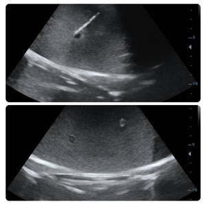 Modello di Pratica per Puntura Guidata ad Ultrasuoni Scalptek, 4 Lesioni, Materiale Bionico Medico, Modello Multifaccia per Biopsia - Product Image 5