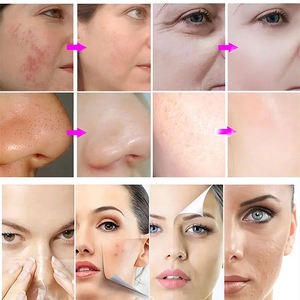 เครื่องดูแลผิวแบบพกพา 3-in-1 ออกซิเจนและคาร์บอนไดออกไซด์ ยอดขายดีที่สุด ปลั๊กแบบ US - Product Image 6