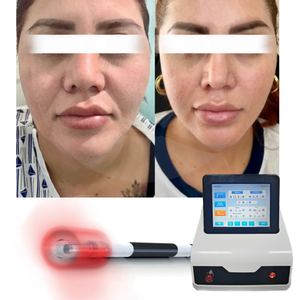 <span class=keywords><strong>Precio</strong></span> de la Máquina <span class=keywords><strong>Láser</strong></span> de Endolifting con Bomba de Liposucción, Lifting Facial Fiberlift, Aprobado por la FDA, Uso Clínico Médico con Certificación CE - Product Image 1