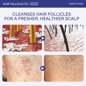Nouveau Design Folliculite <span class=keywords><strong>Psoriasis</strong></span> Shampooing Nettoyage en Profondeur Anti Pelliculaire Cuir Chevelu Secs Démangeaisons Traitement <span class=keywords><strong>Cheveux</strong></span> Shampooing et Après-Shampooing - Product Image 2