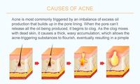 Masque facial médical anti-acné anti-points noirs masque de boue sakura