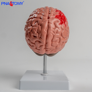 Modelo Anatômico do Cérebro PVC Hemorragia Cerebral e Malformação Arteriovenosa Patologia - Product Image 3