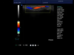 Laptop Echo kardiographie Farbdoppler-Ultraschall gerät für die Kardiologie mit Herz sonde