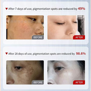 Best-seller, ensemble de soin de la peau pour éliminer les taches noires, correcteur de teint, traitement du mélasma, peeling chimique pour le visage, kits professionnels 3 en 1 - Product Image 3