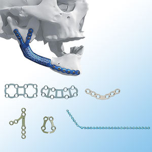 Cadre de reconstruction du visage médial (<span class=keywords><strong>Le</strong></span> Fort) en titane imprimé en 3D sur mesure - Product Image 1