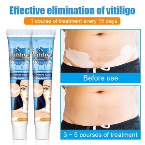 20g d'extrait de plantes pommade pour le vitiligo crème de traitement de la teigne élimination des <span class=keywords><strong>taches</strong></span> <span class=keywords><strong>blanches</strong></span> <span class=keywords><strong>peau</strong></span> tache blanche leucoplasie <span class=keywords><strong>maladie</strong></span> - Product Image 4