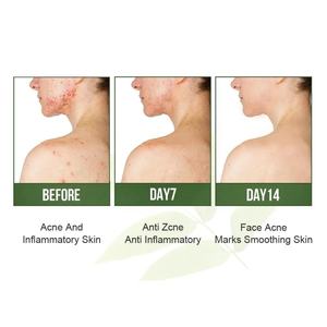 Lot de 5 produits naturels et biologiques pour le soin du visage, anti-acné, à l'huile d'arbre à thé australienne, pour le soin de la peau - Product Image 6