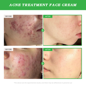 Atacado Whitening Creme Anti-Acne Creme Facial Com Ceramida Ácido Salicílico Hidrolisado Planta Colágeno Creme para o Rosto - Product Image 6