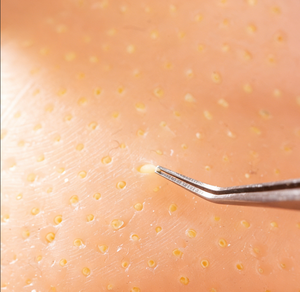 Juguete Sensorial Antiestrés de Silicona para Apretar Granos y Espinillas con Inyecciones - Modelo de Acné - Product Image 4