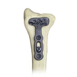 Placa de Titanio de Bloqueo para <span class=keywords><strong>Radio</strong></span> <span class=keywords><strong>Distal</strong></span> Anatómico CANWELL, Placa de <span class=keywords><strong>Radio</strong></span> 16, Implante Ortopédico para Trauma de Muñeca, <span class=keywords><strong>Fractura</strong></span> Ósea - Product Image 1