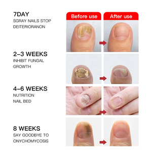 Patchs de soin doux pour les ongles abîmés avec coussinets hydrocolloïdes souples - Product Image 2