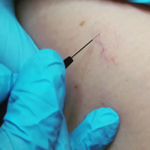 Máquina de eliminación de venas rojas y <span class=keywords><strong>arañas</strong></span> <span class=keywords><strong>vasculares</strong></span> RBS para uso doméstico, reducción vascular de sangre roja de 980nm, <span class=keywords><strong>precio</strong></span>. - Product Image 2