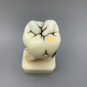 Модель стоматологической патологии кариес Пародонтит Демонстрация патологии полости рта Стоматологическое образование и обучение - Product Image 2