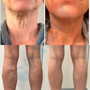 Système laser triple 980 nm, 1470 nm, 635 nm pour la chirurgie minimalement invasive, la thérapie vasculaire et la plateforme de rajeunissement cutané - Product Image 6