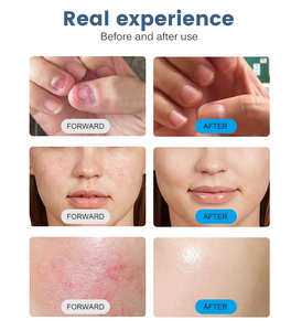 Портативный лазерный аппарат 5-в-1 для физиотерапии и косметологии 980 нм, 2025 года, для удаления сосудов, лечения грибка ногтей и онихомикоза - Product Image 2