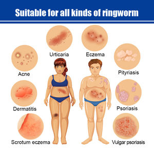 Crème en Gros Marque Blanche à Base de Plantes pour Dermatite Prurit Psoriasis Infection Fongique Urticaire Plaques Pommade Anti-démangeaisons - Product Image 2