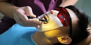 YP apribottiglie odontoiatriche in plastica retrattori ortodontico morbido guancia labbra materiali usa e getta - Product Image 5