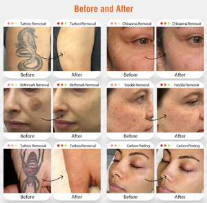 เครื่องเลเซอร์กำจัดรอย<span class=keywords><strong>สัก</strong></span> OEM ODM ปี 2026 รุ่นใหม่ ปิโกวินาที กำลังไฟ 3000 วัตต์ ND YAG สำหรับฟื้นฟูผิวและกำจัดจุดด่างดำ - Product Image 6